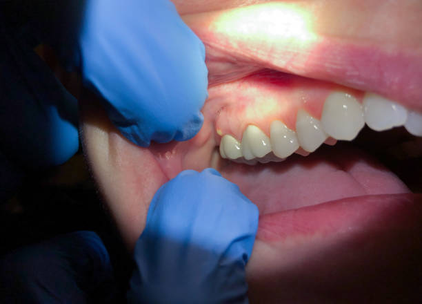 Best Emergency Dental Care for Abscessed Tooth in Fincastle, TN